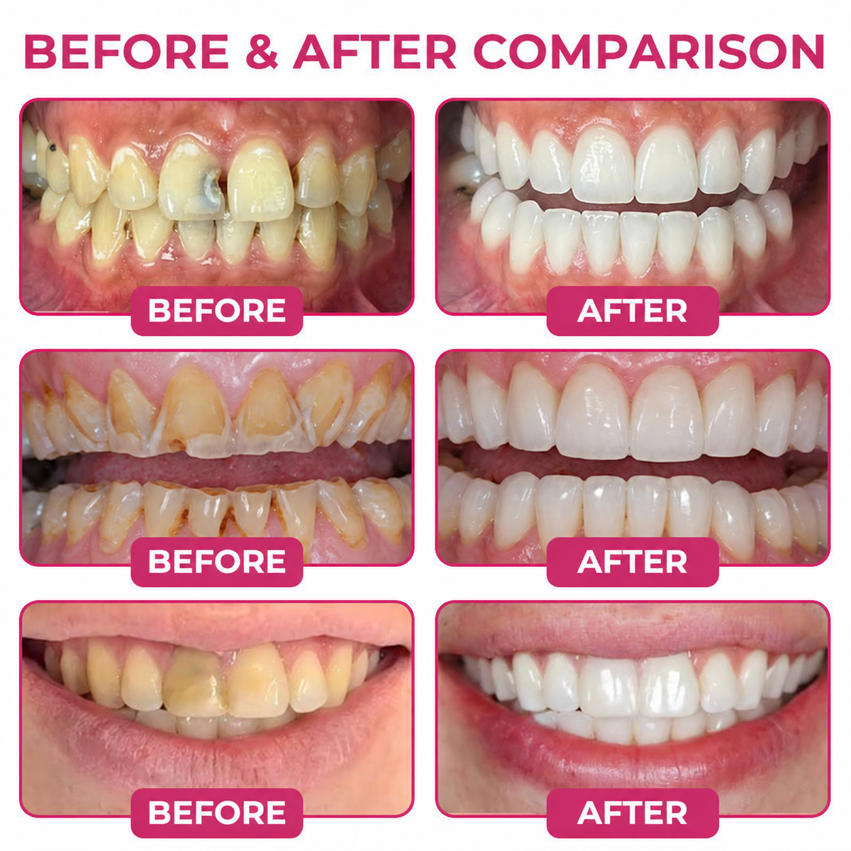 🇺🇸Roliney® DenPerm Cavity-Repair Natural Enamel Filling Gel
