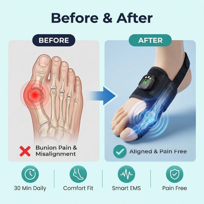 🏆ZORVL™Nexalign Pro - EMs Bunion Corrector