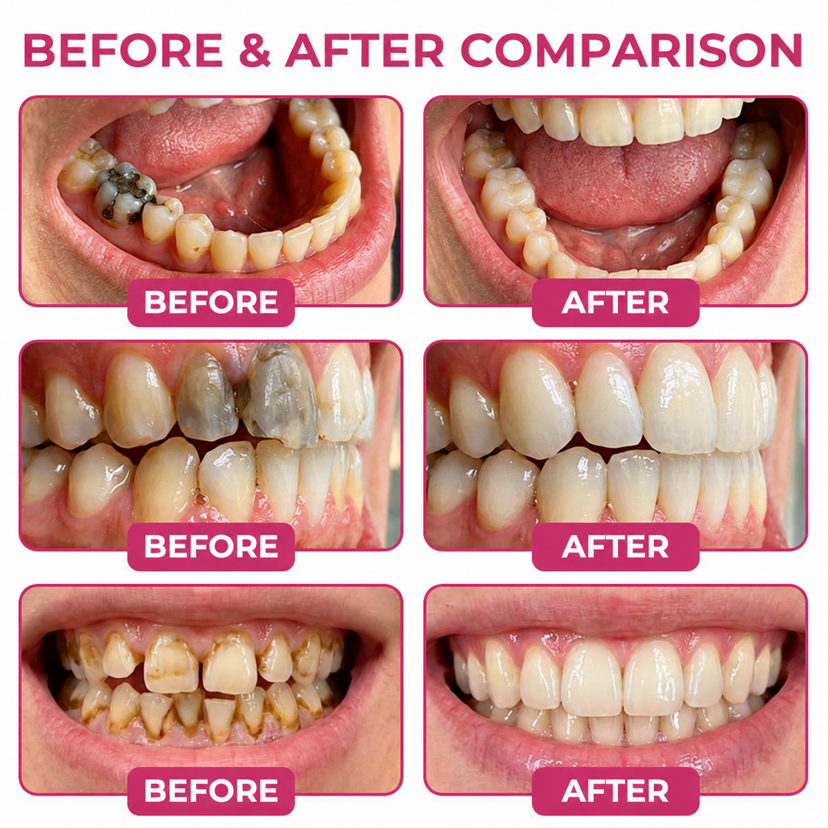🇺🇸Roliney® DenPerm Cavity-Repair Natural Enamel Filling Gel