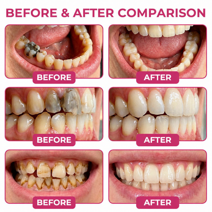 🇺🇸Roliney® DenPerm Cavity-Repair Natural Enamel Filling Gel